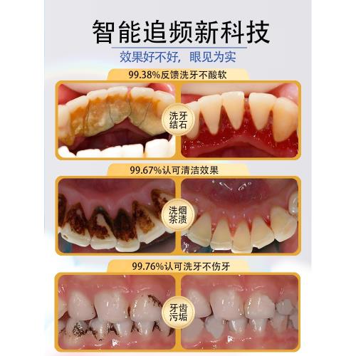 白蒂詩超聲波洗牙器潔牙儀洗牙齒污垢去除牙結石神器牙醫專用機器