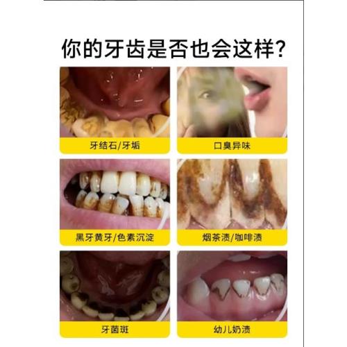 月兒彎彎超聲波洗牙器沖牙結石去除神器潔牙儀牙齒污垢除牙石家用